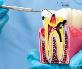 NHA KHOA BẢO TỒN - NHIỄM TRÙNG TỦY RĂNG LÀ GÌ?