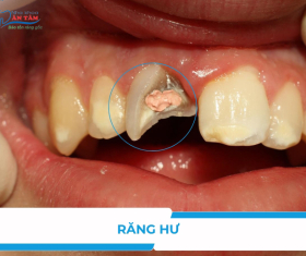 NHA KHOA BẢO TỒN - DẤU HIỆU NHẬN BIẾT RĂNG HƯ TỔN VÀ CÁCH ĐIỀU TRỊ AN TOÀN