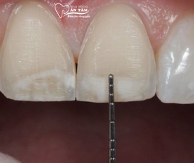 NHA KHOA BẢO TỒN - CÓ NÊN MÀI RĂNG CỬA KHÔNG?