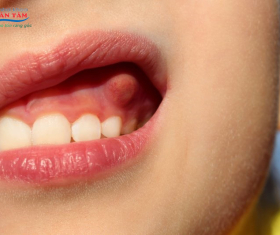 NHA KHOA BẢO TỒN - ÁP XE RĂNG VÀ NHỮNG ĐIỀU CẦN BIẾT