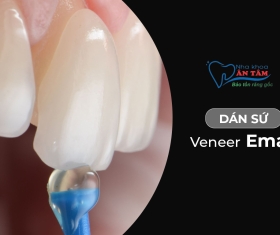 NHA KHOA BẢO TỒN - DÁN VENEER RĂNG THƯA CÓ BỀN KHÔNG?