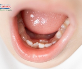NHA KHOA BẢO TỒN - RĂNG MỌC LẪY: NGUYÊN NHÂN VÀ CÁCH KHẮC PHỤC HẬU QUẢ
