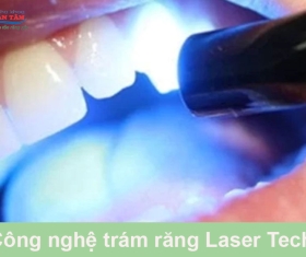 NHA KHOA BẢO TỒN - CÔNG NGHỆ TRÁM RĂNG LASER TECH