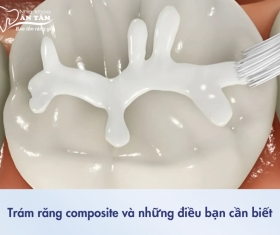 NHA KHOA BẢO TỒN - NHỮNG ĐIỀU CẦN BIẾT VỀ TRÁM RĂNG COMPOSITE
