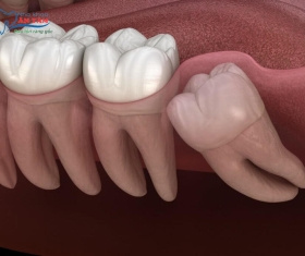 NHA KHOA BẢO TỒN - LỢI ĐANG SƯNG CÓ NHỔ RĂNG KHÔN ĐƯỢC KHÔNG?
