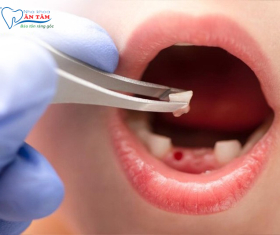 NHA KHOA BẢO TỒN - KHI NÀO NÊN NHỔ RĂNG SỮA CHO TRẺ EM