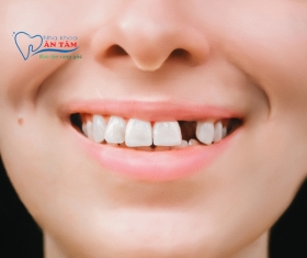 NHA KHOA BẢO TỒN - MẤT RĂNG: HẬU QUẢ VÀ CÁCH KHẮC PHỤC