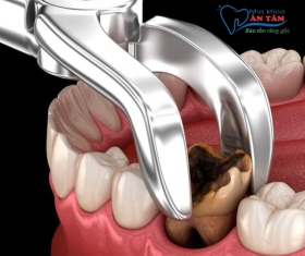NHA KHOA BẢO TỒN - NHỔ RĂNG CẤM CÓ BỊ HÓP MÁ KHÔNG?