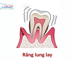 NHA KHOA BẢO TỒN - RĂNG BỊ LUNG LAY DO ĐÂU?