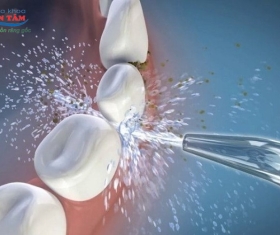 NHA KHOA BẢO TỒN - BỌC RĂNG SỨ CÓ NÊN DÙNG MÁY TĂM NƯỚC KHÔNG?