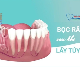 NHA KHOA BẢO TỒN - CÓ NÊN BỌC RĂNG SỨ SAU KHI LẤY TỦY?