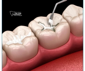 NHA KHOA BẢO TỒN - TÁC HẠI CỦA VIỆC TRÁM RĂNG SAI KỸ THUẬT