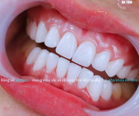 NHA KHOA BẢO TỒN - NƯỚU RĂNG LÀ GÌ: CHỨC NĂNG VÀ CÁCH CHĂM SÓC NƯỚU