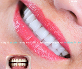 NHA KHOA BẢO TỒN - RĂNG SỨ BỊ MẺ CÓ TRÁM ĐƯỢC KHÔNG?