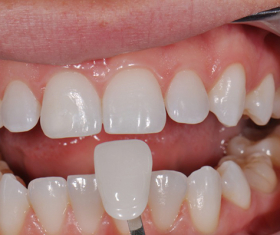 CÁC LOẠI RĂNG SỨ PHỔ BIẾN NHẤT TRÊN THỊ TRƯỜNG HIỆN NAY 