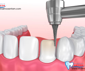 KỸ THUẬT MÀI RĂNG THẾ NÀO ĐÚNG CHUẨN?