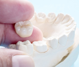 NHA KHOA BẢO TỒN - CÁC LOẠI RĂNG SỨ PHỔ BIẾN NHẤT TRÊN THỊ TRƯỜNG HIỆN NAY 