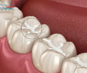 NHA KHOA BẢO TỒN - TRÁM RĂNG PHÒNG NGỪA?