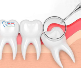 NHA KHOA BẢO TỒN - VIÊM LỢI TRÙM RĂNG KHÔN