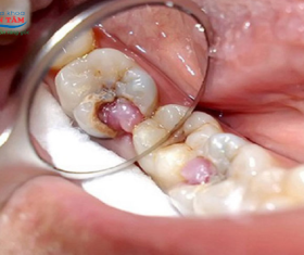 NHA KHOA BẢO TỒN - RĂNG SÂU LỒI THỊT CÓ SAO KHÔNG?