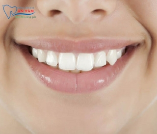 NHA KHOA BẢO TỒN - RĂNG KHỂNH LÀ GÌ?