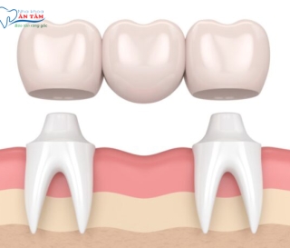 NHA KHOA BẢO TỒN - NHƯỢC ĐIỂM CỦA CẦU RĂNG SỨ LÀ GÌ?