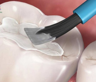 NHA KHOA BẢO TỒN - TRÁM RĂNG TẠM THỜI ĐỂ LÀM GÌ?