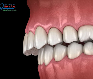 NHA KHOA BẢO TỒN - HÔ HÀM TRÊN VÀ BIỆN PHÁP KHẮC PHỤC HIỆU QUẢ