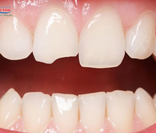 NHA KHOA BẢO TỒN - TRÁM RĂNG CỬA BỊ MẺ CÓ ĐAU KHÔNG?