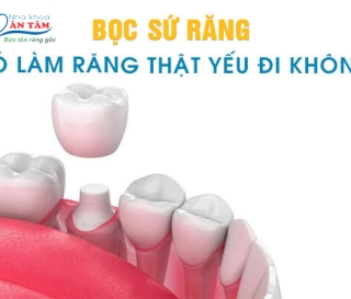NHA KHOA BẢO TỒN - BỌC RĂNG SỨ CÓ LÀM RĂNG THẬT YẾU ĐI KHÔNG?