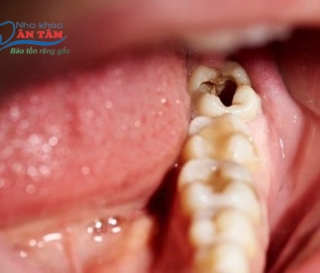 NHA KHOA BẢO TỒN - RĂNG SỐ 8 BỊ SÂU VỠ CÓ NGUY HIỂM KHÔNG?