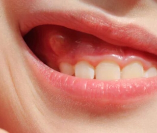 NHA KHOA BẢO TỒN - CÁCH NHẬN BIẾT VIÊM NHA CHU Ở TRẺ EM