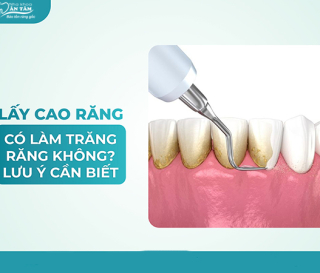 NHA KHOA BẢO TỒN - LẤY CAO RĂNG CÓ LÀM TRẮNG RĂNG KHÔNG?