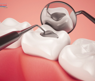 NHA KHOA BẢO TỒN - TRÁM RĂNG CÓ ĐAU KHÔNG?