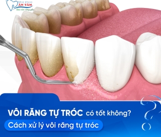 NHA KHOA BẢO TỒN - VÔI RĂNG TỰ TRÓC ĐƯỢC KHÔNG?