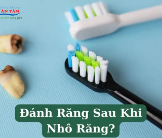 NHA KHOA BẢO TỒN - NHỔ RĂNG XONG BAO LÂU THÌ ĐƯỢC ĐÁNH RĂNG?