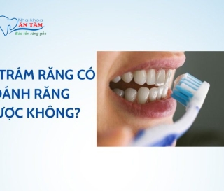 NHA KHOA BẢO TỒN - SAU KHI TRÁM RĂNG XONG CÓ ĐÁNH RĂNG ĐƯỢC KHÔNG?