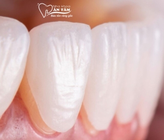 NHA KHOA BẢO TỒN - DÁN SỨ VENEER KHÔNG MÀI RĂNG LÀ GÌ?