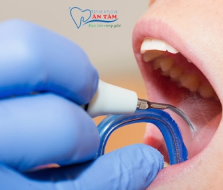 NHA KHOA BẢO TỒN - CẠO VÔI RĂNG CÓ BỊ Ê BUỐT KHÔNG?