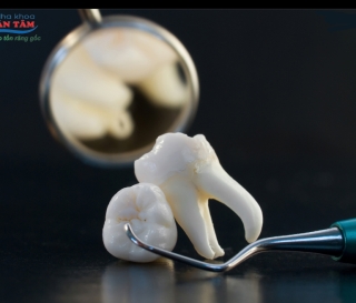 NHA KHOA BẢO TỒN - NHỔ RĂNG KHÔN BAO LÂU THÌ LÀNH?