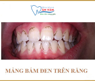 NHA KHOA BẢO TỒN - CÁCH LÀM SẠCH MẢNG BÁM ĐEN TRÊN RĂNG HIỆU QUẢ