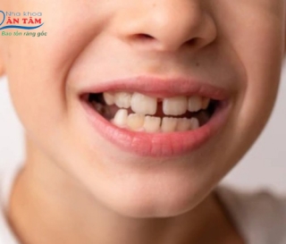 NHA KHOA BẢO TỒN - KHÔNG CÓ MẦM RĂNG VĨNH VIỄN CÓ SAO KHÔNG?