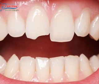 NHA KHOA BẢO TỒN - RĂNG BỊ GÃY CÓ TRÁM ĐƯỢC KHÔNG?