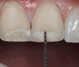 NHA KHOA BẢO TỒN - CÓ NÊN MÀI RĂNG CỬA KHÔNG?