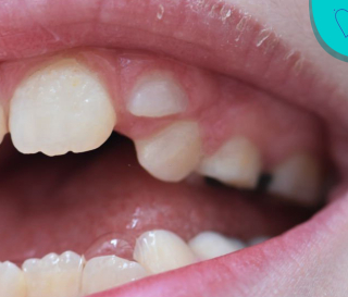 NHA KHOA BẢO TỒN - NGUYÊN NHÂN BỊ MỌC RĂNG THỪA