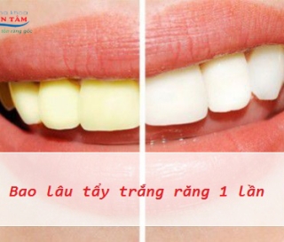 NHA KHOA BẢO TỒN - NÊN TẨY TRẮNG BAO LÂU MỘT LẦN