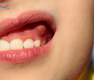 NHA KHOA BẢO TỒN - ÁP XE RĂNG VÀ NHỮNG ĐIỀU CẦN BIẾT