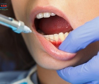 NHA KHOA BẢO TỒN - THUỐC TÊ TRONG NHA KHOA LÀ GÌ?