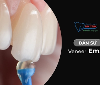 NHA KHOA BẢO TỒN - DÁN VENEER RĂNG THƯA CÓ BỀN KHÔNG?