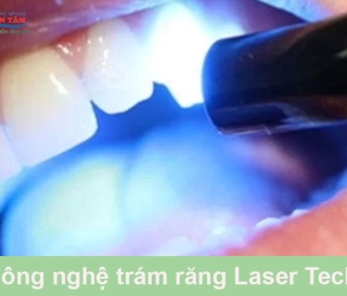 NHA KHOA BẢO TỒN - CÔNG NGHỆ TRÁM RĂNG LASER TECH